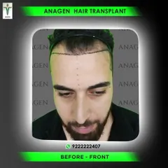 A frontal view of the hairline design before the procedure. This meticulous planning is crucial for achieving a natural and aesthetically pleasing result that suits the patient's facial structure.