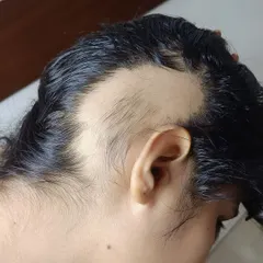 Alopecia Areata can affect anyone at any age, causing distinct bald patches as seen here. With the right diagnosis and treatment plan, it is possible to manage the condition and encourage hair regrowth.