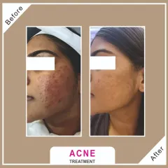 This client was struggling with active acne and post-inflammatory marks. A series of specialized chemical peels helped clear the breakouts and fade the discoloration for much clearer skin.
