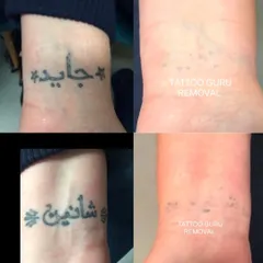 Here are two examples of name tattoos in a non-English script removed from the wrist area. My laser is effective on different ink styles and densities.