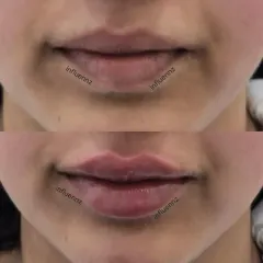 Here you can see how we've added volume and definition with lip fillers. The result is a plumper, more hydrated appearance that still looks completely natural.