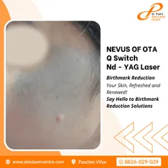This shows a case of Nevus of Ota, a type of birthmark, which I treat with a Q-Switch Nd-YAG Laser. This advanced treatment is designed to refresh and renew the skin by reducing such pigmentation.
