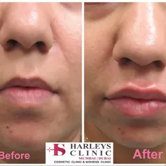 This before and after shows how I use hyaluronic acid fillers for subtle lip enhancement. My goal is to add volume and definition that complements your natural facial structure, resulting in a refreshed and balanced appearance, not an overdone look.