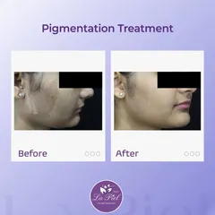 Pigmentation can make skin appear uneven and dull, but with targeted treatments, we can restore its natural clarity. This transformation shows a significant reduction in pigmentation, resulting in a brighter and more even-toned complexion, achieved through a plan designed specifically for Indian skin.