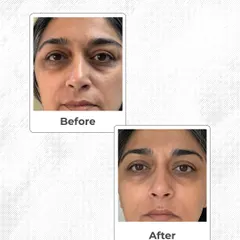 This is a real result from one of my patients. We focused on reducing under-eye wrinkles and fine lines for a fresher, more rested appearance. My goal is always to provide natural-looking anti-aging results that restore your confidence.
