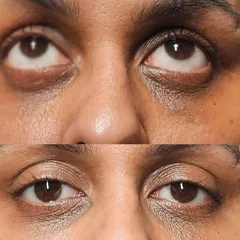 Looking up, you can clearly see the reduction in the deep, shadowy hollows under the eyes after the treatment.