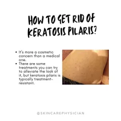 While there is no cure for this harmless genetic condition, there are effective treatments to manage its appearance and improve skin texture.