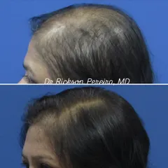 Another angle showcasing the successful regrowth in a case of advanced female pattern hair loss. My approach focuses on using proven treatments and ensuring the patient follows the protocol consistently for the best outcome.