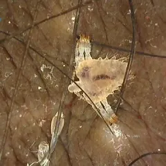 This is a highly magnified image of a pubic louse, or crab louse, clutching a hair shaft alongside its eggs, known as nits. Using a dermatoscope allows for this level of detail, which is crucial for identifying the parasite and confirming the diagnosis of this particular STI.