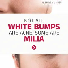 Identifying Milia: The Bumps That Aren't Acne. Those tiny white bumps, especially around the eyes, are often milia, not whiteheads. This post explains what they are (trapped keratin) and why you can't pop them.