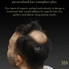 After a detailed consultation with Aman, we identified his specific hair loss pattern. Our team then designed a personalized hair transplant plan to address the balding on his crown and deliver long-lasting, natural results.