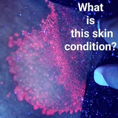 This image shows a skin condition called Erythrasma as seen under a special diagnostic tool called a Wood's lamp. The distinct coral red glow is caused by bacteria and helps me differentiate it from a fungal infection. An accurate diagnosis is the first step to effective treatment, as not every itch or rash in the groin is an STD.