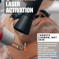 Next, we use a Q-switched Nd:YAG laser to activate the carbon. The laser energy is absorbed by the carbon particles, vaporizing them and providing ultra-precise exfoliation without harming the surrounding skin tissue.