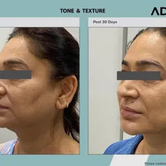 A side profile view highlighting the textural improvements and evening of skin tone achieved with the AdvaTx laser. The treatment effectively addresses sun damage and signs of aging.