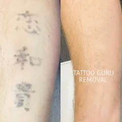 An example of an older tattoo with faded characters being cleared from an arm. Even aged tattoos can be effectively removed.