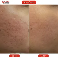 Notice the dramatic improvement in both the redness and the pitted texture of the skin. This transformation showcases how our treatments reduce inflammation and resurface the skin for an even tone and feel.