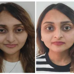 This before and after showcases a subtle, natural-looking enhancement. Our goal is to make you look like the best version of yourself, where the results are visible but the treatment isn't.