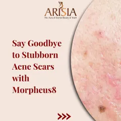Say goodbye to stubborn acne scars with Morpheus8. This treatment is highly effective for resurfacing the skin and promoting deep collagen remodeling to smooth out textural irregularities.