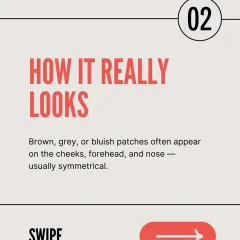 Melasma typically appears as symmetrical brown, grey, or bluish patches on the cheeks, forehead, and nose. This distinct pattern helps me in diagnosing the condition accurately.