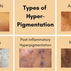Sun spots, freckles, and melasma are distinct conditions that require different approaches. I create tailored treatment plans that may include lasers, peels, or topical creams to effectively target your specific type of hyperpigmentation.