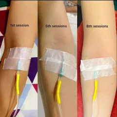 This image demonstrates the typical progression of a multi-session Glutathione treatment. It shows the visible change in skin tone from the first to the eighth session, illustrating the product's efficacy.