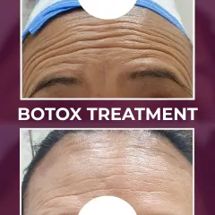 A dramatic reduction in deep-set forehead wrinkles after a Botox treatment. This shows how effective it can be for creating a smoother, more youthful appearance.