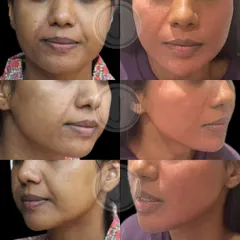 This collage shows the progression of a non-surgical facial contouring treatment. Notice the improved definition along the jaw and the subtle lift in the cheek area, creating a more youthful and balanced facial structure.