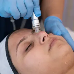 This is a close-up of the HydraPro treatment, which uses a vortex-like suction to remove impurities from pores while simultaneously infusing the skin with hydrating serums.
