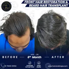 The top-down view highlights the successful hair restoration on the scalp, complementing the new beard.