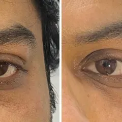 This close-up before-and-after shows a visible reduction in under-eye darkness and puffiness, resulting in a more refreshed appearance.