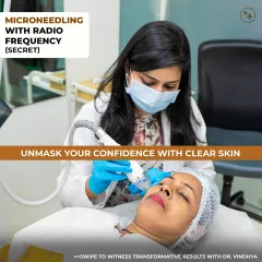 Here, our dermatologist performs the Secret Microneedling RF treatment, also known as Morpheus8. This procedure combines microneedling with radiofrequency energy to remodel collagen deep within the skin, making it highly effective for reducing acne scars and tightening the skin.