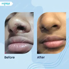 This image displays the result of a lesion removal from the side of the nose. My focus is always on precise excision to ensure the area heals cleanly, blending seamlessly with the surrounding skin.