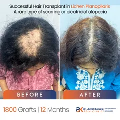 This is a successful hair transplant for a patient with Lichen Planopilaris, a rare scarring alopecia that permanently destroys hair follicles. Surgery is only possible when the disease is inactive. This case, involving 1800 grafts, shows that even complex conditions can be treated with proper diagnosis and expert surgical skill.
