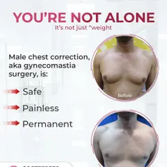 This image highlights the key benefits of male chest correction surgery. It is a safe, effective, and permanent solution for gynecomastia. The before and after photos show a clear reduction in chest protrusion, leading to a more defined physique.
