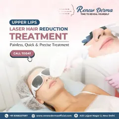 We offer precise treatments for smaller areas like the upper lips. This graphic shows a client getting upper lips laser hair reduction, a quick and effective way to remove unwanted facial hair without the pain of threading or waxing.