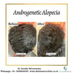 This top-down view clearly shows the successful treatment of androgenetic alopecia. The patient's hair appears significantly fuller and the scalp is less visible after a course of customized medical therapy.