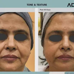 A frontal before and after showcasing the power of AdvaTx for skin rejuvenation. Note the significant fading of age spots and sun damage, leading to a brighter and more uniform complexion.