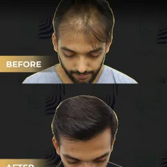 A top-down view of the corrective procedure. The 'before' shows sparse and poorly placed grafts. The 'after' shows how we achieved even density and natural coverage across the scalp.