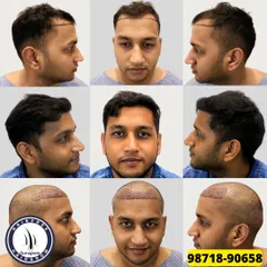 A complete 360-degree view of a patient's 8-month journey. We used 1550 grafts to restore his hairline, and these nine images show the process from every angle, before and after.