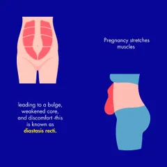 Pregnancy stretches the abdominal muscles, which can lead to a bulge and weakened core known as diastasis recti. This is a common condition that surgery can correct.