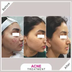 A multi-session acne treatment journey. You can see the progression from active, inflamed acne to clearer, calmer skin with reduced scarring over time.
