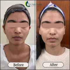 This is a great example of the skin transformation possible with Morpheus8. You can see a visible reduction in acne marks and a significant improvement in overall skin texture and jawline definition after the treatment.