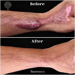 This patient came to us with a significant scar on his forearm from a road traffic accident. This before and after shows the progress of his scar revision treatment. Our goal is to improve the texture and pigmentation of the scar, making it much less noticeable over time.