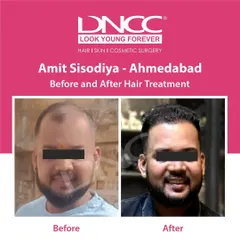 This before and after from my Ahmedabad clinic shows how a well-executed hair treatment can completely change your appearance and restore a youthful look. The smile in the 'after' photo says it all.