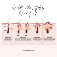 This diagram illustrates the progression of acne within the hair follicle, from a microcomedone to a fully inflamed cyst or nodule. Understanding this pathology is key to targeted treatment.