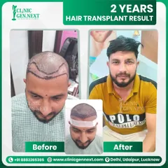 The difference between the day of the procedure and the result two years later is clear. My focus is on creating a natural hairline that lasts, ensuring your investment in yourself stands the test of time.