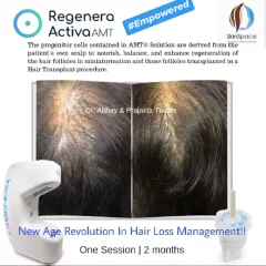 This before-and-after photo shows the powerful results of one Regenera Activa session over two months. The treatment helped empower this patient by restoring hair volume and reducing the visibility of the scalp.