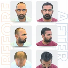 This is what a complete transformation looks like. For Mr. Durgesh, I used the RT-FUE Sapphire technique to place 3,447 grafts. We addressed the receding hairline, the thinning sides, and the crown area to create a full, natural look from every angle.