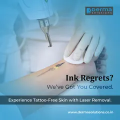 Whether your tattoo is large or small, the goal is a clean slate. Here, I am performing a laser removal procedure on a delicate tattoo on the foot. My approach ensures that only the ink is targeted, preserving the health of the surrounding skin.