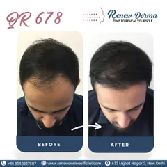 The proof is in the pictures. This client's before and after photos show a clear increase in hair density after completing the QR678 therapy. We focus on achieving natural-looking fullness.